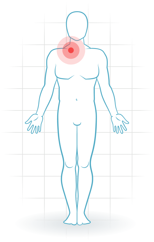 pijnlocatie Sternoclavicular injury